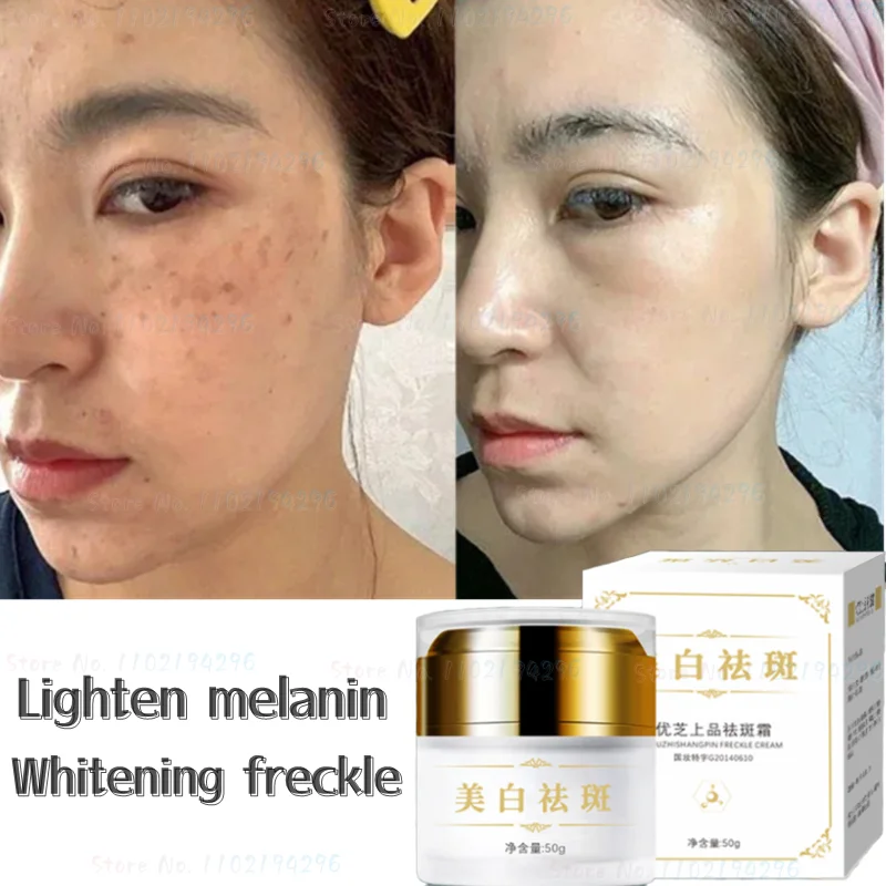 

Unisex Whitening Freckle Cream Freckles Chloasma Sunburn Spot Dissolving Cream Acne Remover Cream Dark Spot Remover for Face