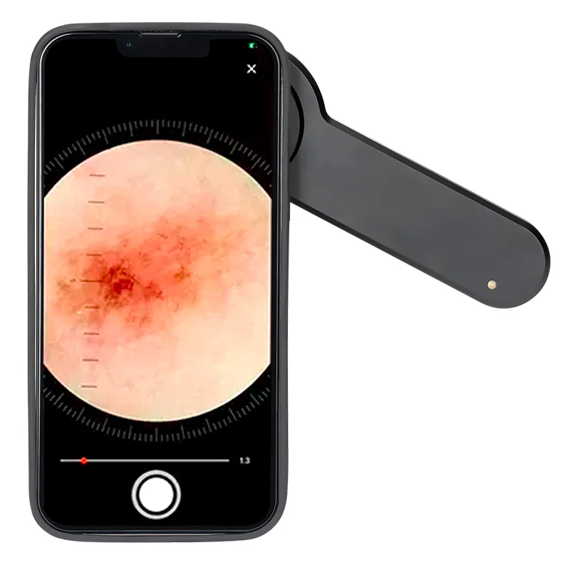 

Premium Quality Dermatoscope 10x Magnify Zoom Lens For Dermatology Clinical Mole Diagnosis