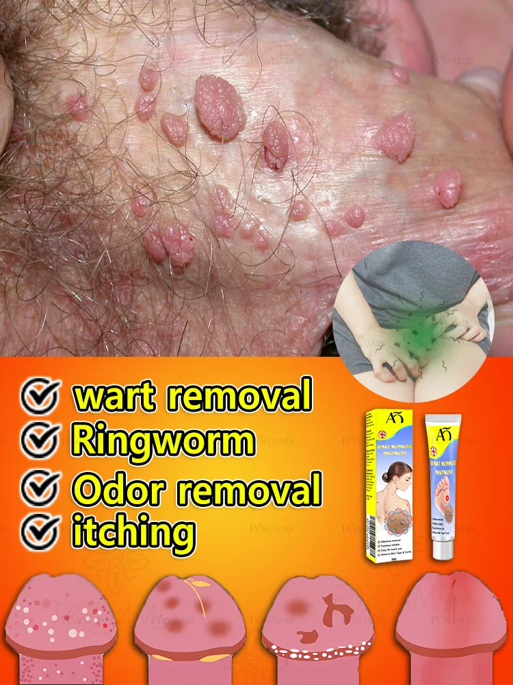 Крем для удаления бородавок ВПЧ Генитальные бородавки Подошвенные