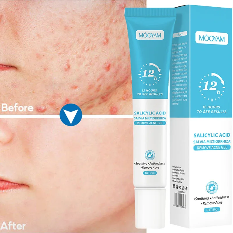 

Salicylic Acid Acne Removal Cream Pimple Remover Fade Acne Spots Marks Gel Shrink Pores Oil Control Moisturizing Soothing Care