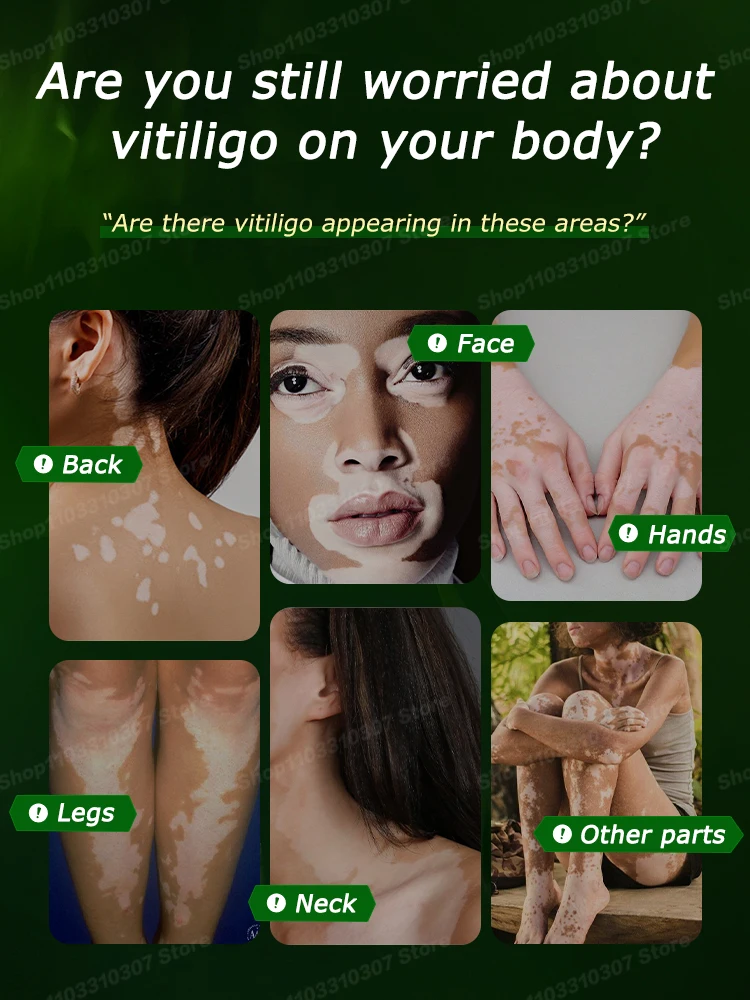 Vitiligo Blu-Ray ручка улучшает белые пятна