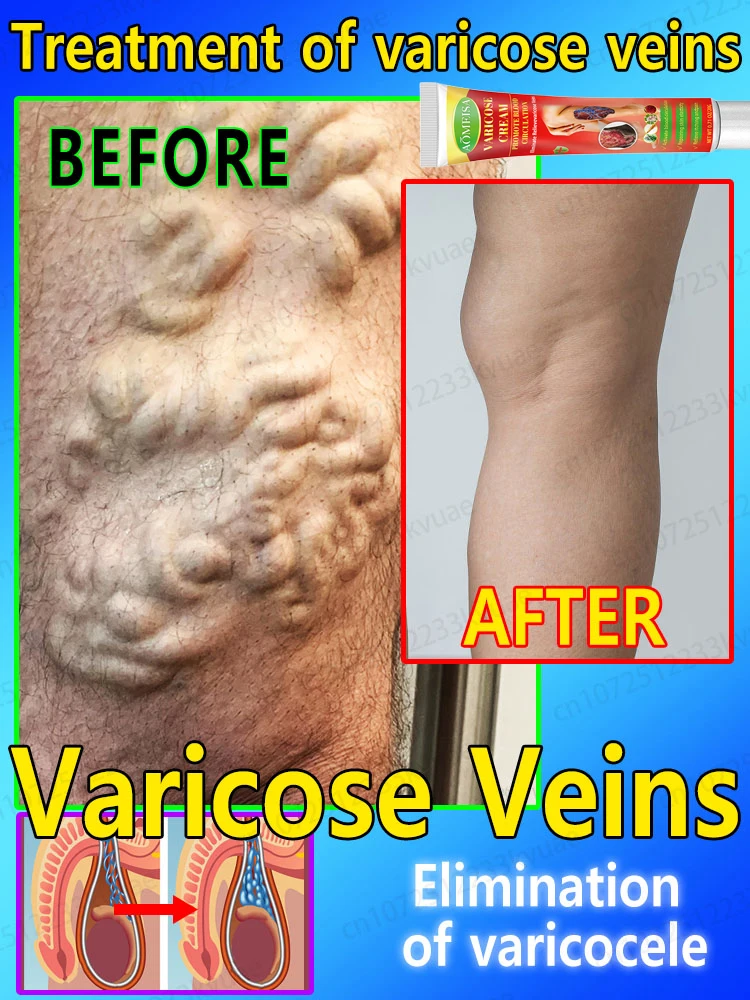 Мазь от варикозного расширения вен 7-дневное лечение опухших кровеносных сосудов