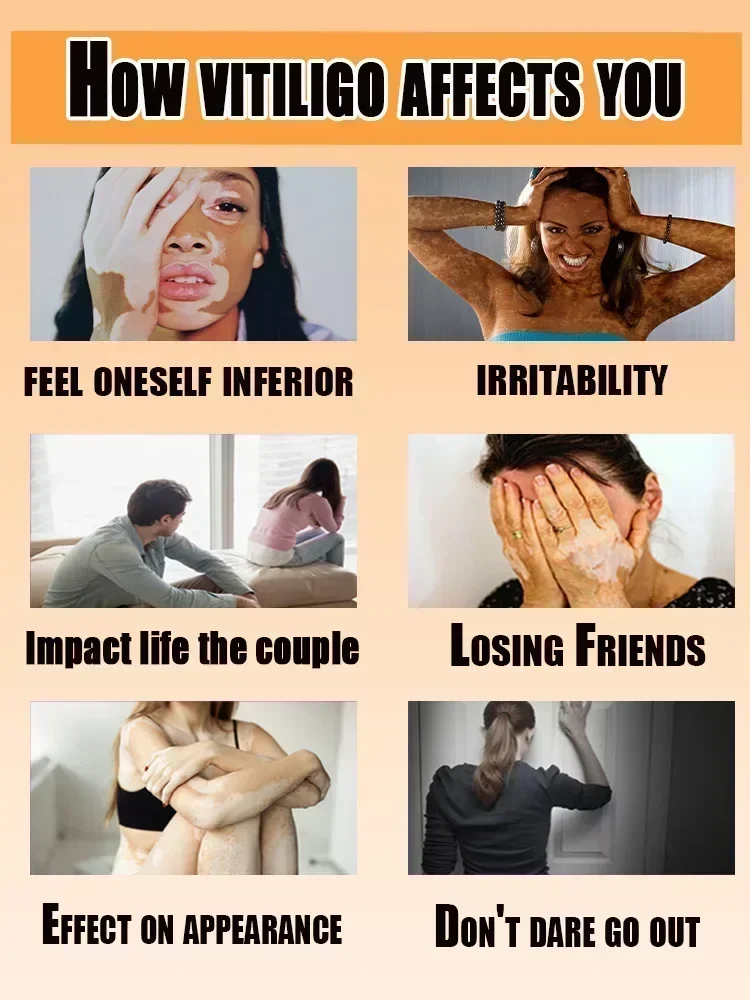Крем Vitiligo улучшает белое пятно xxx