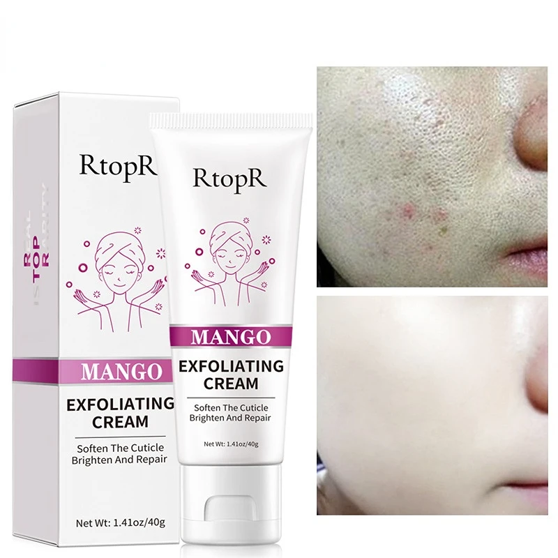 RtopR Mango Blackhead Remover Nose Mask Acne Treatment Oil Control Shrink Pores Deep Cleansing Black Face Mask T Zone Skin Care
