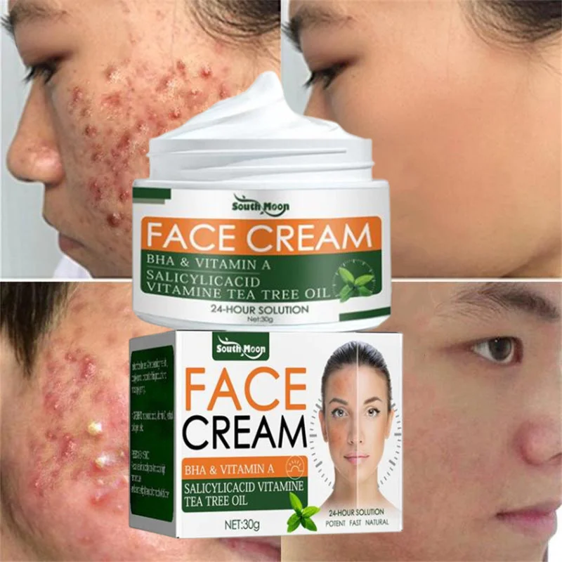 

Effective Acne Removal Cream Treatment Acne Scar Shrink Pores Oil Control Whitening Moisturize Face Salicylic acid Herb Acne
