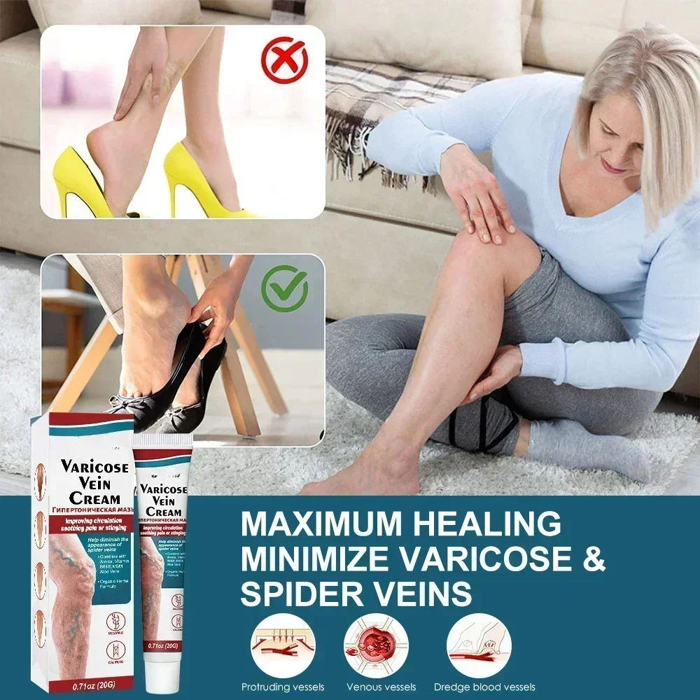 Varicose Veins Removal Cream Effective Treatment Vasculitis Earthworm Spider Leg Pain Repair Plaster Phlebitis Relief Ointment