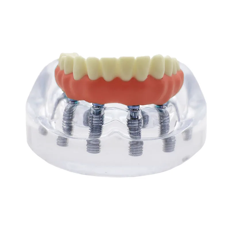 1 шт. модель зубного имплантата 6 имплантатов реставрация зубов стоматолог