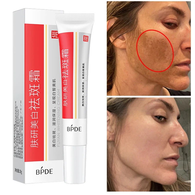 Whitening Freckle Cream Remove Acne Dark Spots Anti-Freckle Fade Pigmentation Melasma Brighten Essence Beauty Health Skin Care