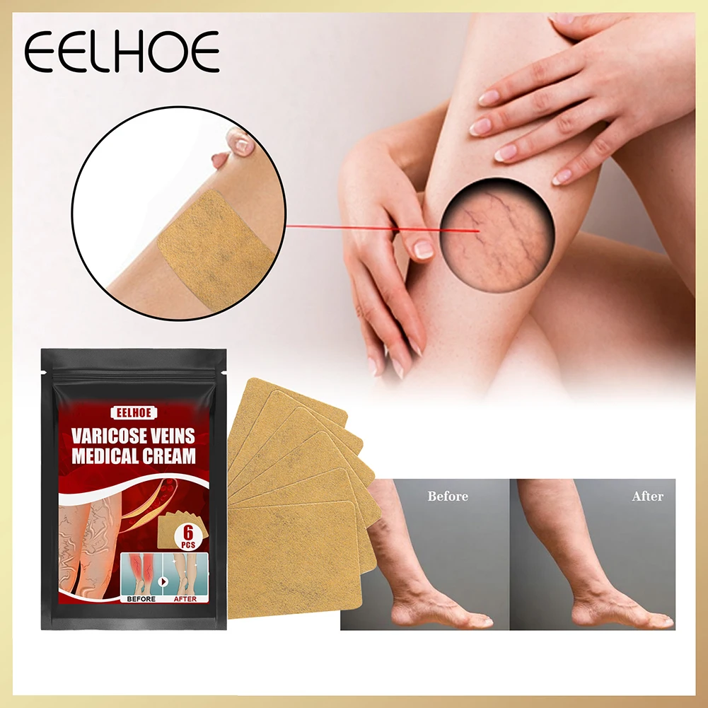 

6pcs Varicose Vein Treatment Patch Leg Sore Swelling Relief Plaster Patch Earthworm Leg Health Care Sticker