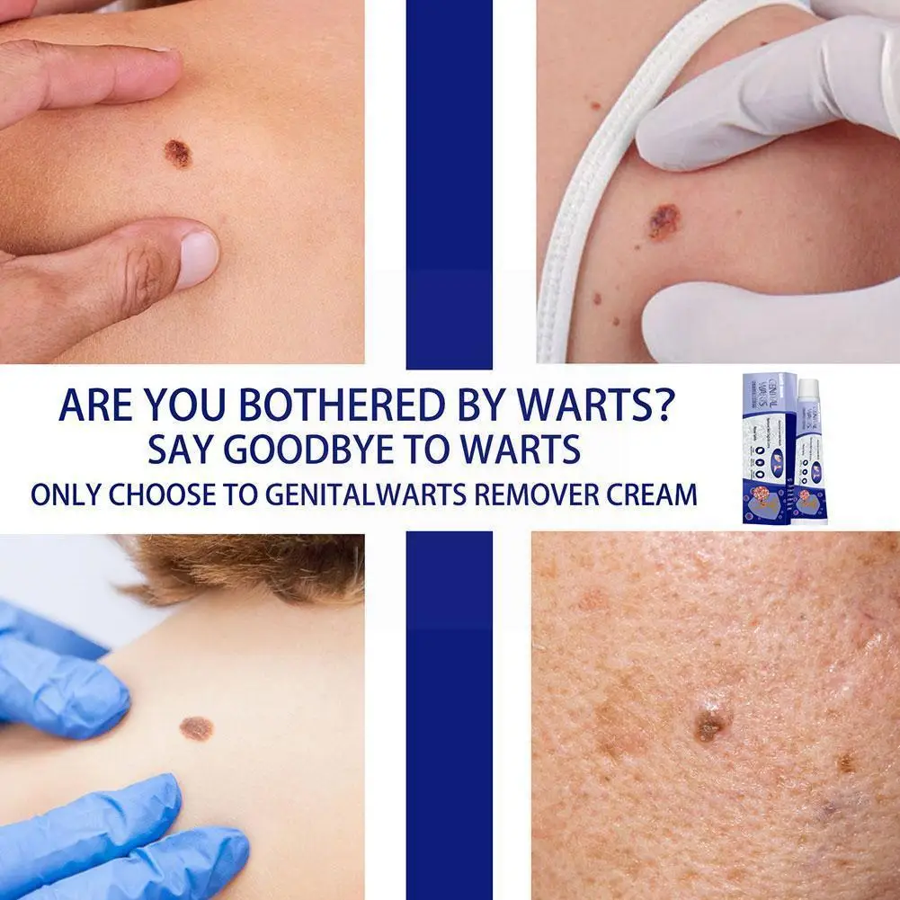 

New 20g Warts Remover Antibacterial Ointment Wart Treatment Cream Skin Plaster Tag Remover Extract Corn Skin Care Herbal L0o3