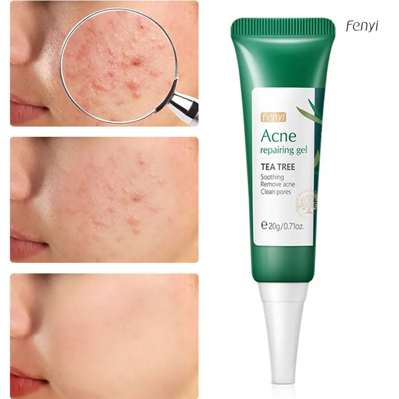 Acne Removal Gel Acne Scars Remover Oil Control Moisturizing Whitening Dark Spots Face Acne Cream Oily Acnes Skin Care 20g