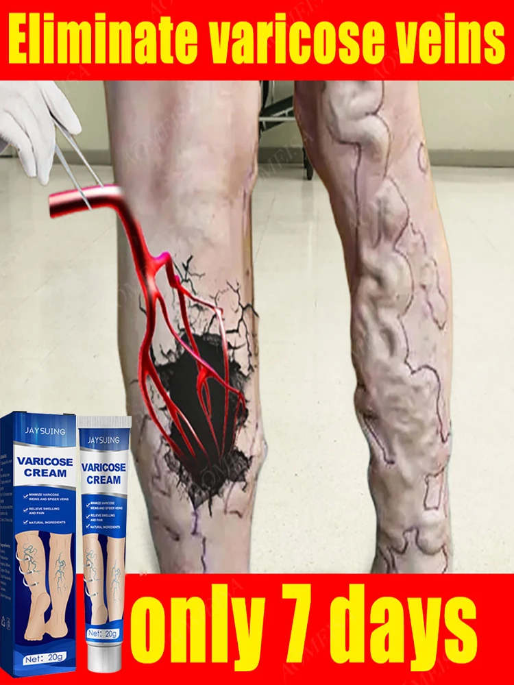 

Spider blood vessels varicose veins Effective varicose vein relief cream to relieve vasculitis phlebitis spider pain treatment