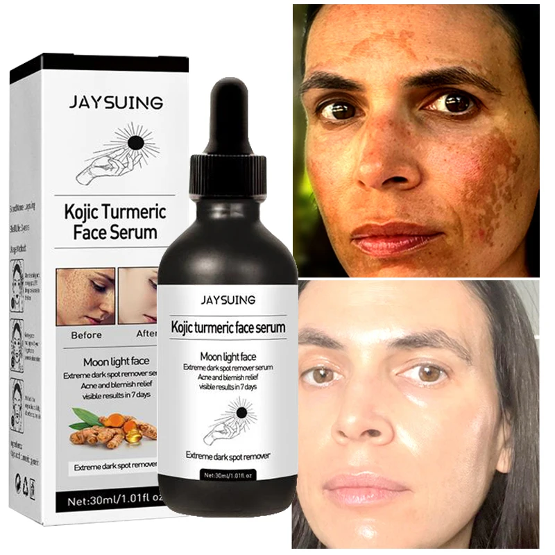 

Facial Freckle Essence That Whitens Reduces Dark Spots Moisturizes Turmeric Serum That Eliminates Melanin Brightens Skin Tone