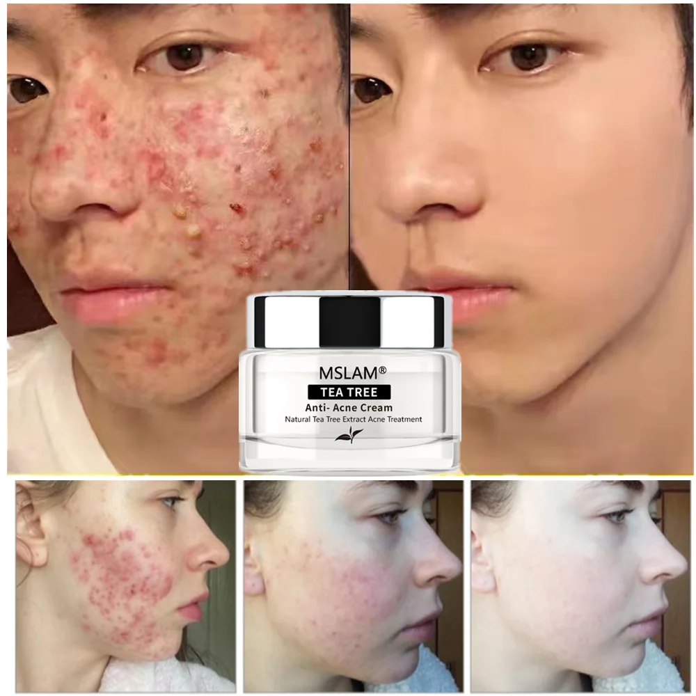 New Herbal Chinese Medicine Acne Cream Safe&Gentle Remove Acne Acne Cream for Clearing Severe Acne From Face Body TSLM1 Skin