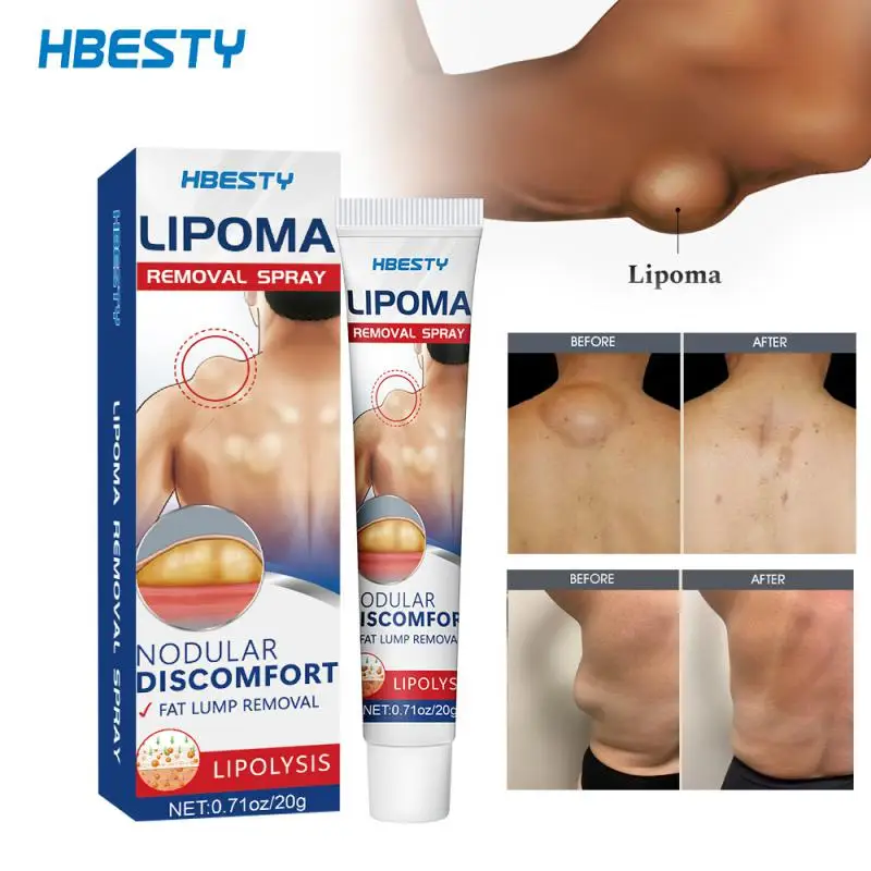 

Lipoma Removal Cream Relief Pain Treat Skin Swelling Lipolysis Cellulite Fat Lump Nodule Removal Ointment Anti-tumor Plaster