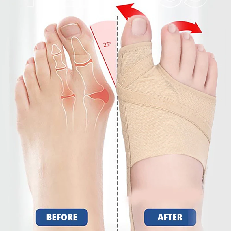 

1Pair Big Toe Separator Bunion Corrector Hallux Valgus Correction Device Bone Thumb Orthopedic Forefoot Pad Foot Straightener