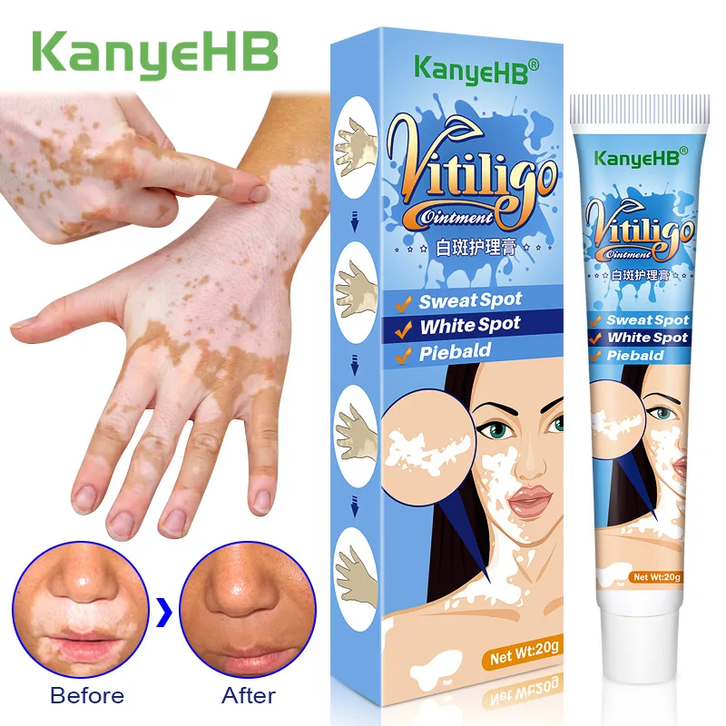 Эффективный крем для удаления белых пятен лечение Vitiligo спот от пота пьейлысый