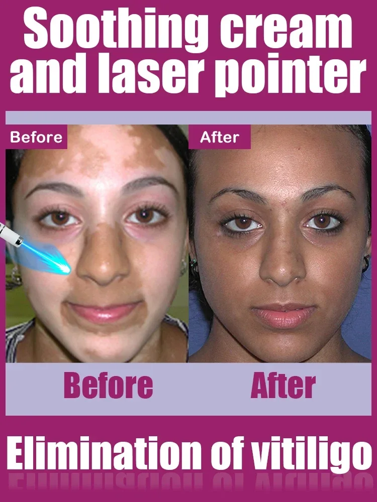 Витилиго - Технология лазии синего света с белыми пятнами