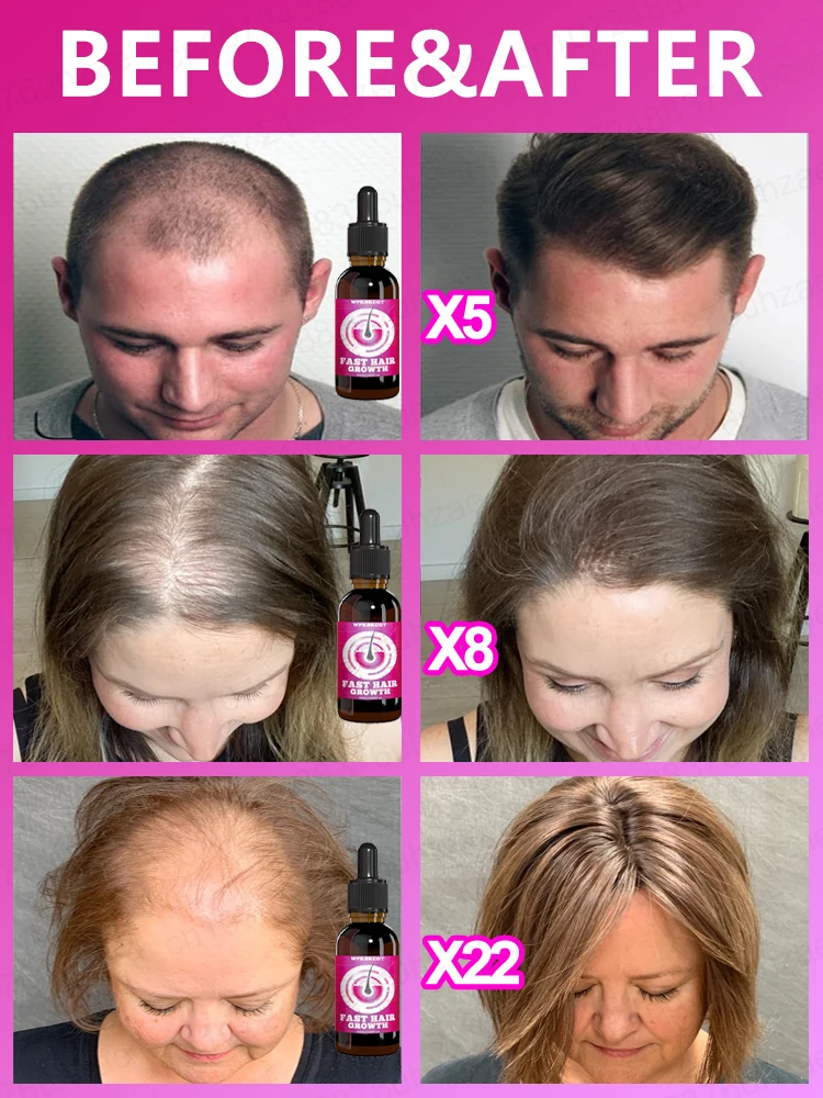 Массаж и расслабляет кожу головы для снятия стресса выпадения волос.