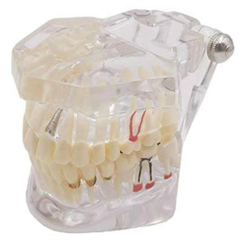 

1Pcs Oral Hygiene Implant Disease Teeth Model For Teaching PVC/Resin Oral Health Care Teeth Whitening Teeth Model