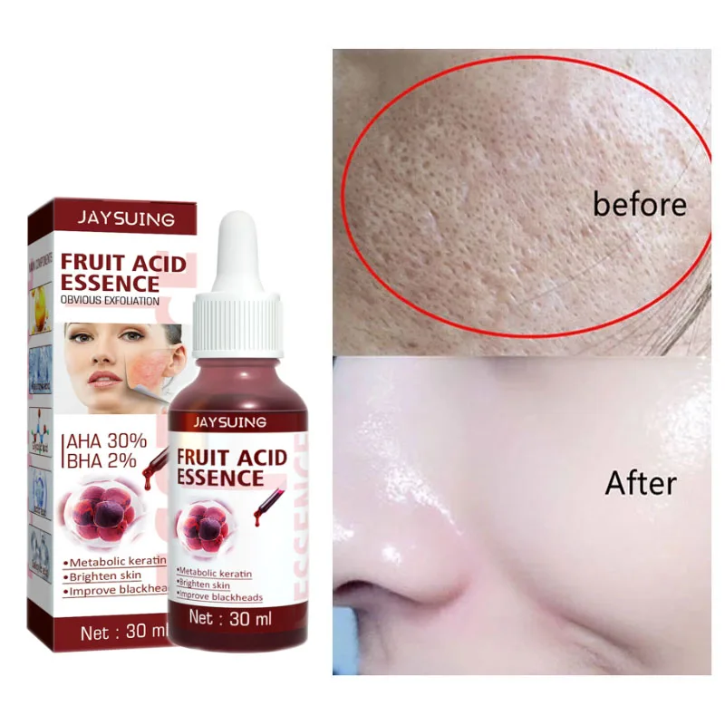 

Фруктовая кислота, сыворотка для сужения пор лица, лечение акне с салициловой кислотой, увлажняющая эссенция для контроля жирности кожи, уд...