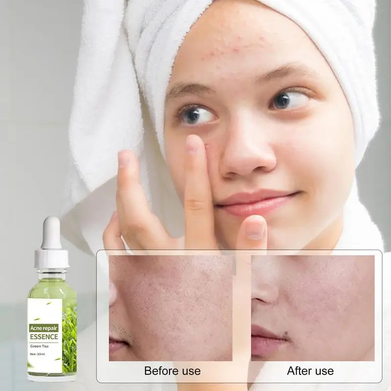 

Pimple Spot Serums Shrink Pores Essence Black Head Pimple Spot Removal Long Lasting Face Moisturizer Pimples Repair Essence