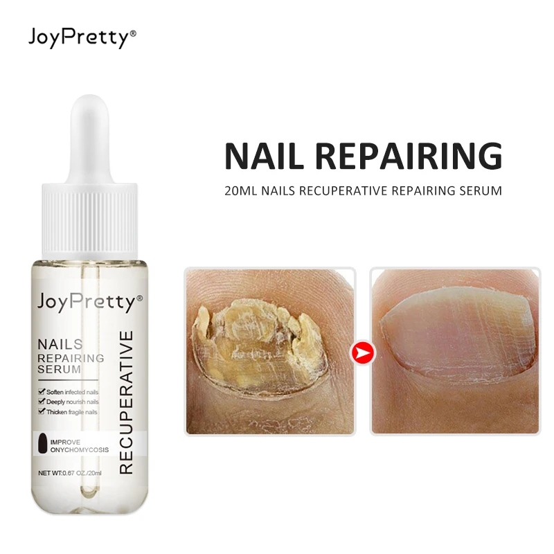 Сыворотка JoyPretty для лечения грибка ногтей средство против грибков уход за ногами