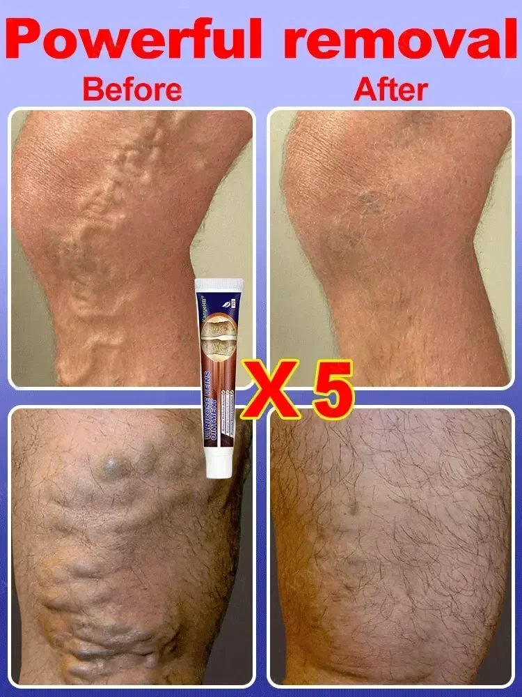 Крем против варикозного расширения вен вариусы салеп Penghilang васкутис Obat Salep крем