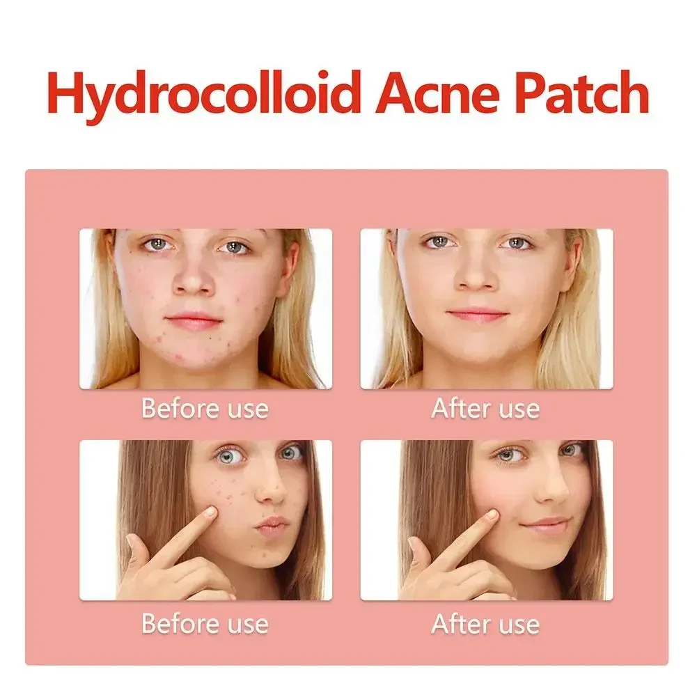 144 шт. патчи для удаления прыщей на лице