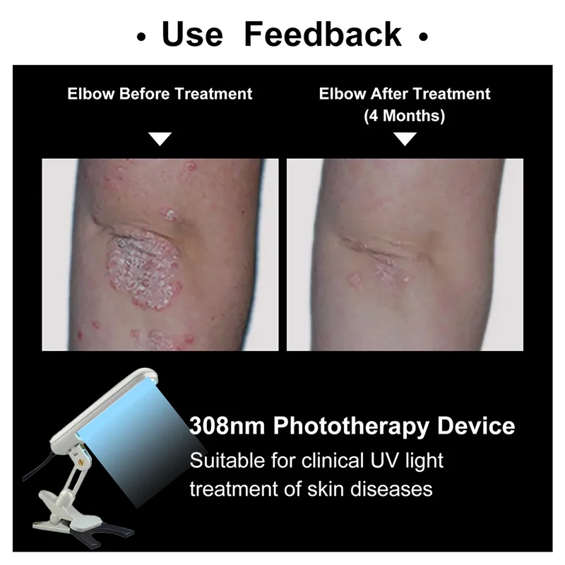 УФ-лазерная лампа для фототерапии борьбы с витилиго псориазом белой пяткой