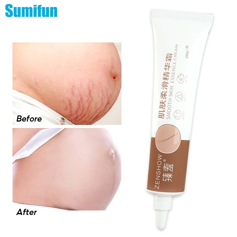 

1 шт., Крем Для Удаления растяжек