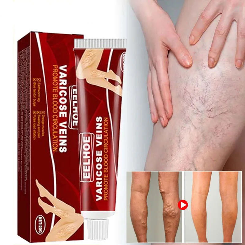 

Herbal Varicose Veins Relief Cream Vasculitis Phlebitis Spider Pain Relief Ointment Herb Plaster Beauty Body Legs Care 20g