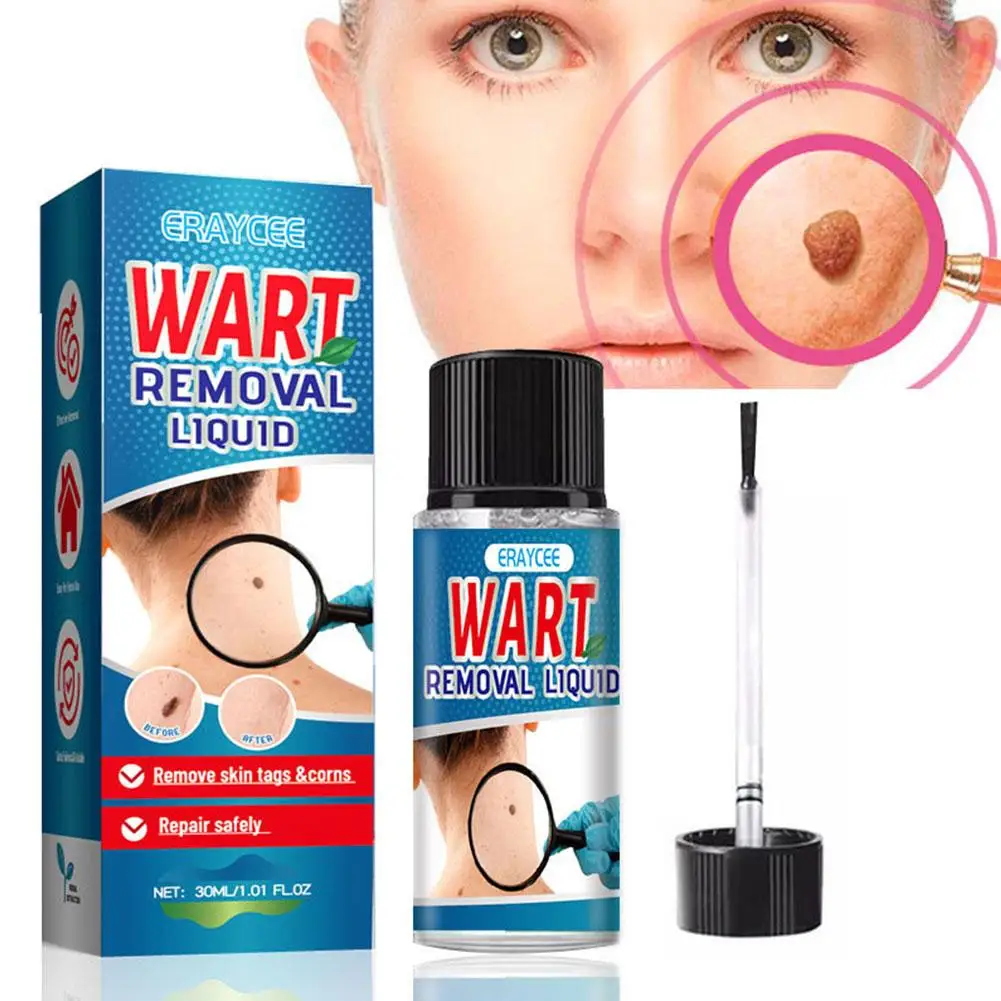 

30ml Remover Warts Removal Relief Medical Treatment Antibacterial Foot Meat Wart Liquid Calluses Skin Corn Cream Flat Care Q7B8