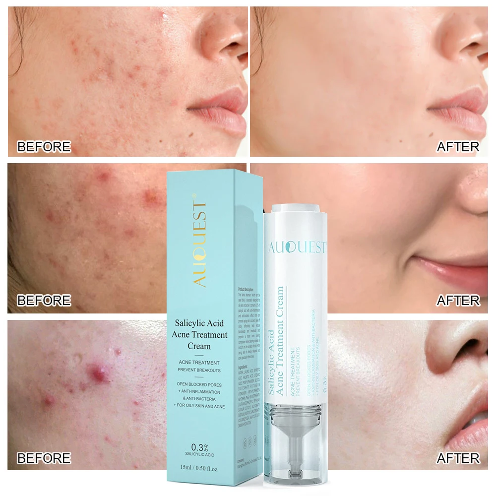 

Acne Removal Serum Salicylic Acid Acne Treatment Face Cream Remove Blackheads Whitening Moisturizing anti-acne Gel Shrink Pores
