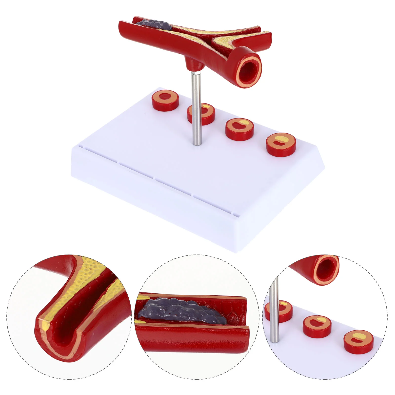 

Vascular Model Mannequin Human Atherosclerosis Anatomical Models Cardiovascular Tool Medical Show Display Teaching Pvc Elderly