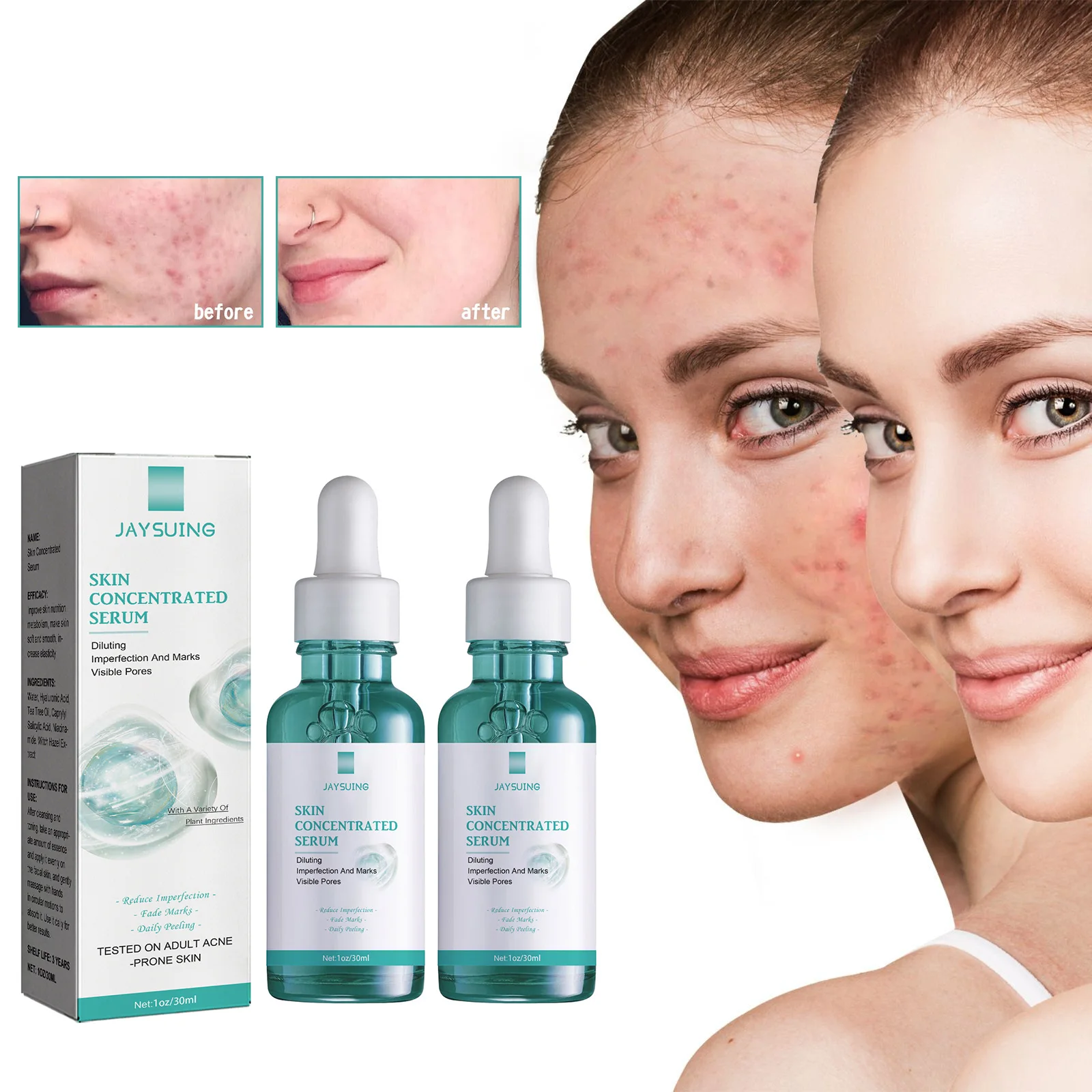 

Acne Removal Serum Eliminate Pimples Reduce Acne Marks Repair Treatment Spot Oil Control Shrinking Pore Whiten Anti-acne Essence