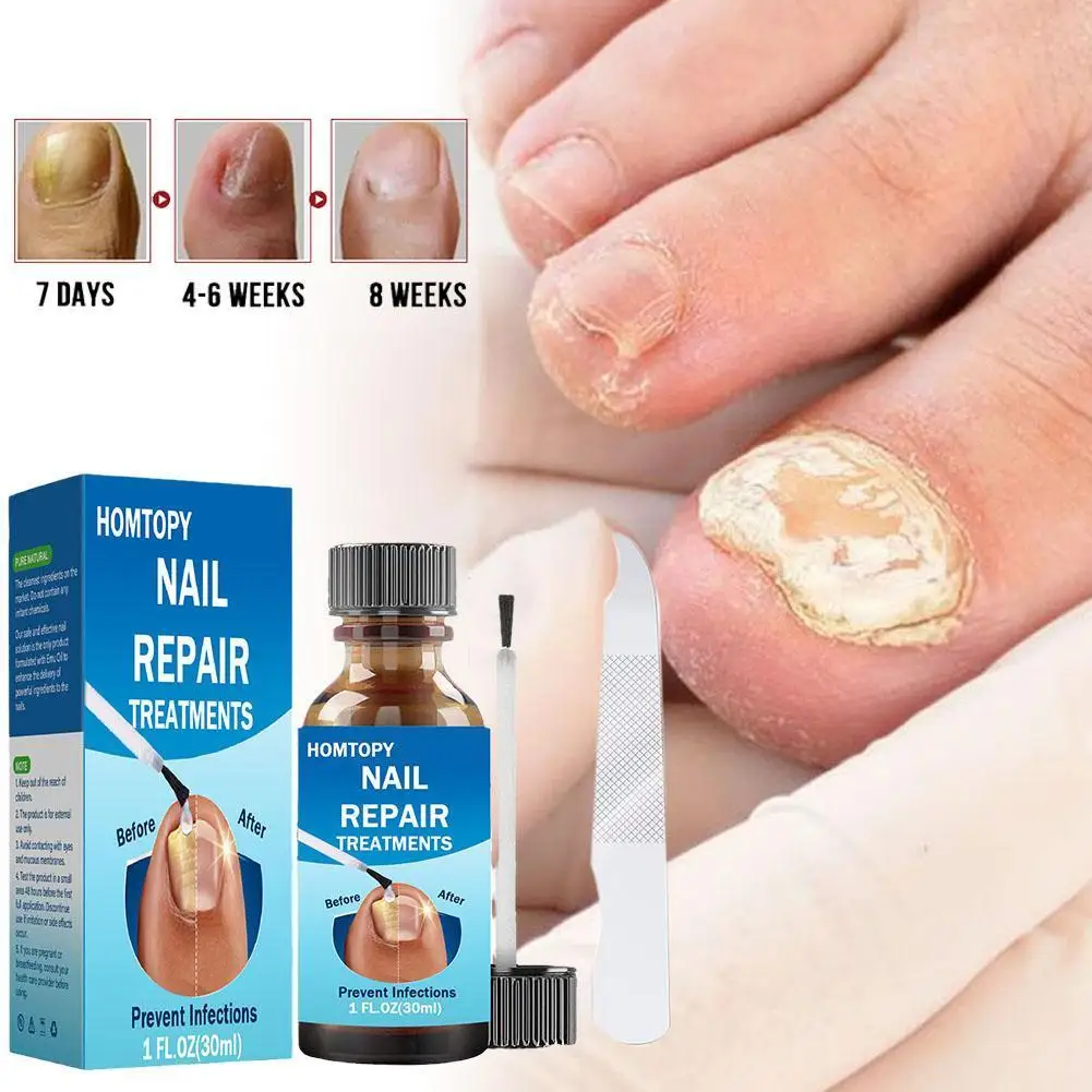 

Nail Fungus Treatment Serum Hand Foot Nails Repair Toe 30ml Health Care Anti-infective Cream Gel Onychomycosis Removal Fung M4B7