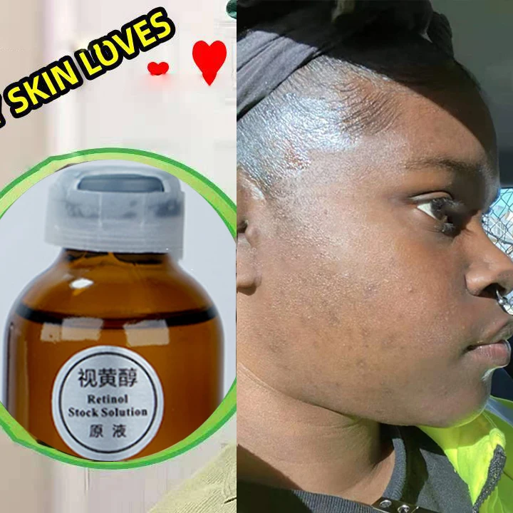 

Отбеливающий ночной крем Retinol Plus, глубоко питает кожу, уменьшает рубцы от акне, удаляет темные солнечные пятна, гиперпигментные морщины