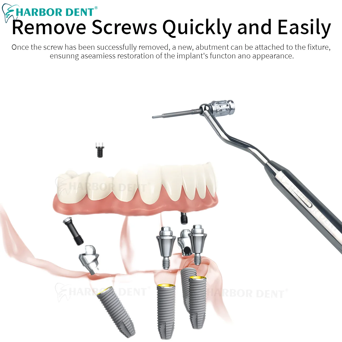 Набор для удаления поврежденных винтов и стоматологических имплантов