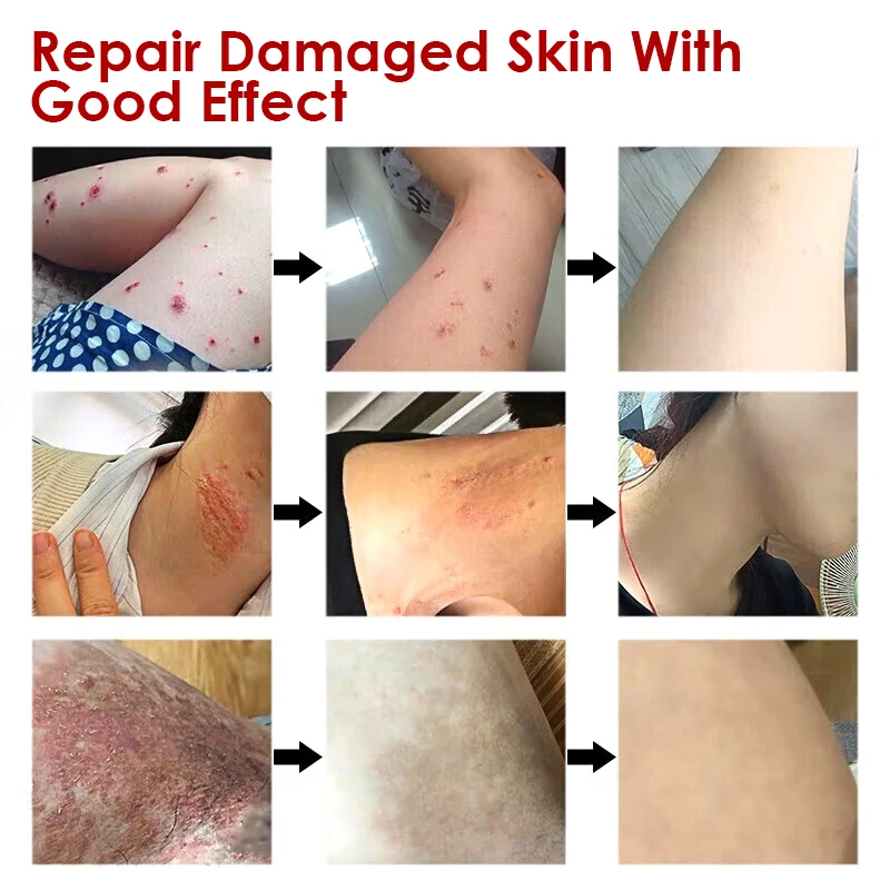 2 шт. антибактериальный крем для лечения псориаза