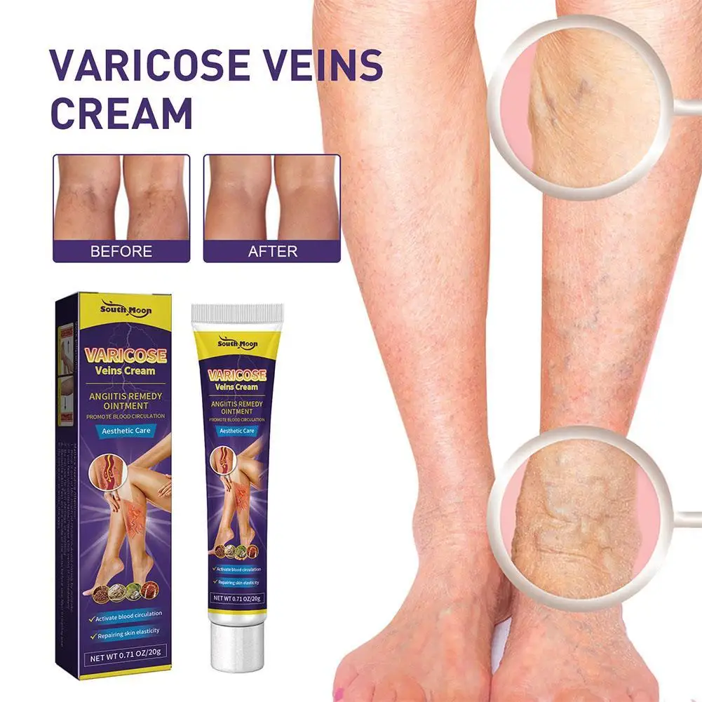 

20g Varicose Veins Cream Relieve Vasculitis Phlebitis Spider Effective Pain Relief Ointment Herb Plaster Beauty Body Care