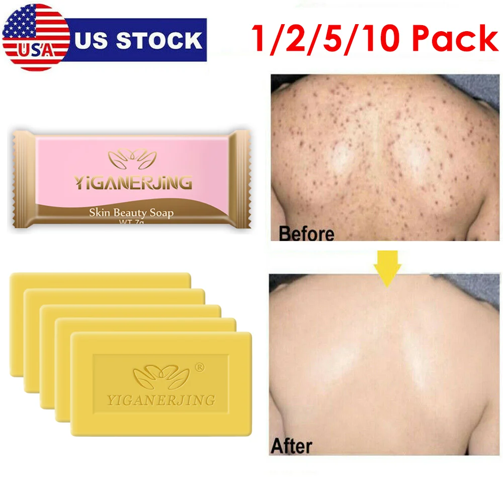 

10Pcs Sulfur Soap Anti-mite Acne Soap Oil-control Acne Treatment Whitening Cleanser Moisturizing Removal Pimple Pore Fungus Soap