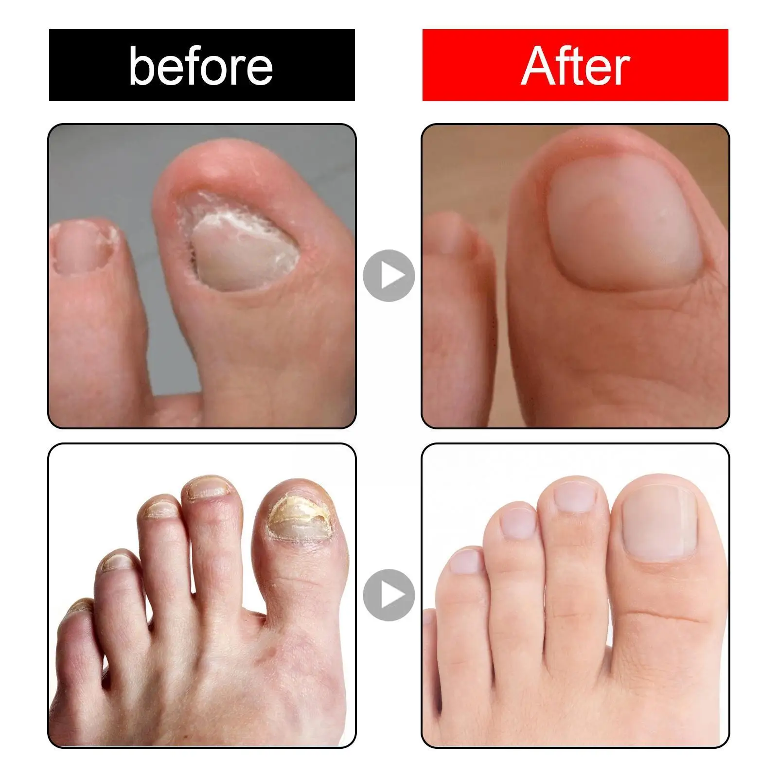 

10ml Fungal Nail Treatment Essential Oil Hand And Foot Whitening Toe Infection Polish Gel Nail Care Removal Feet Fungus Nai Y4h6