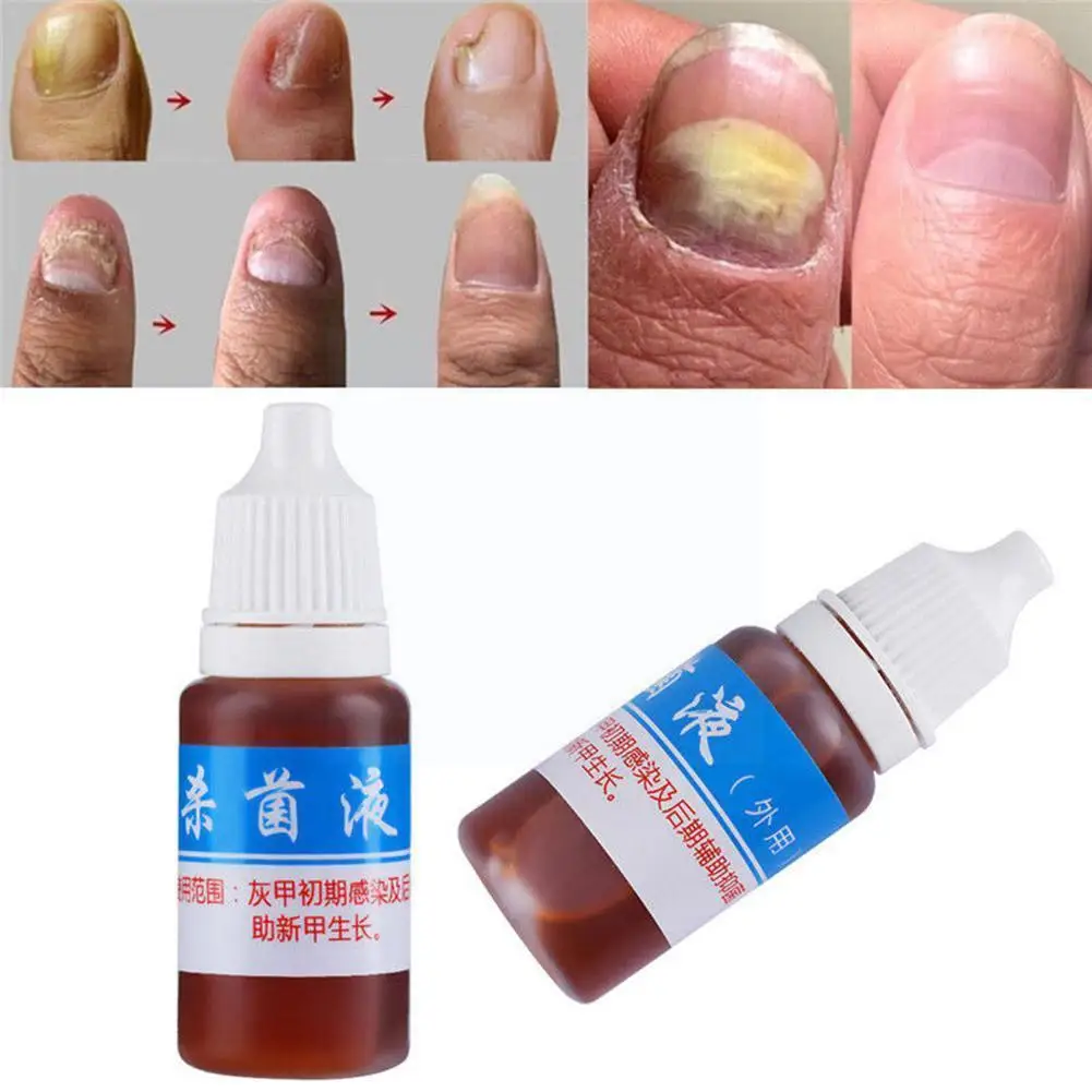 

10ml Skin Care Nail Repair Liquid Cleanser Onychomycosis Remover A9q7
