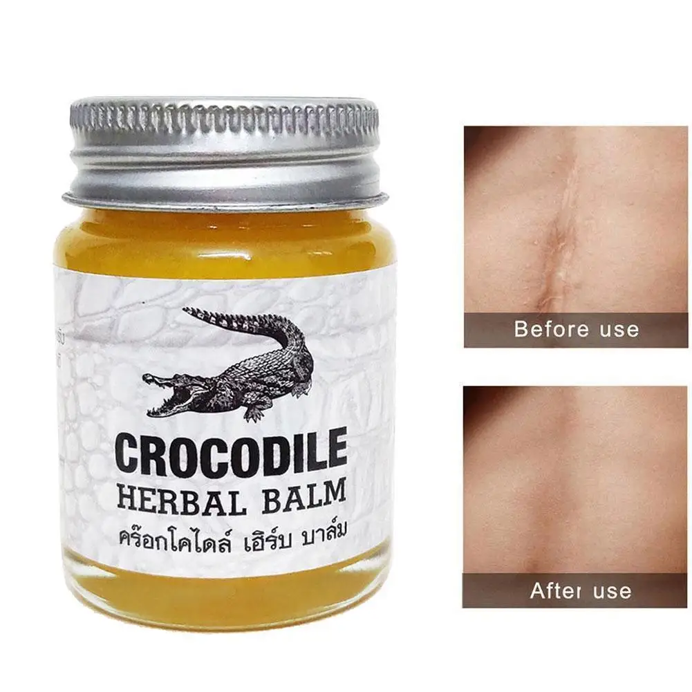 

Crocodile Scar Removal Cream Thailand Herbal Balm Whitening Remover Acne Marks Scar Face Corrector Stretch Pigmentation