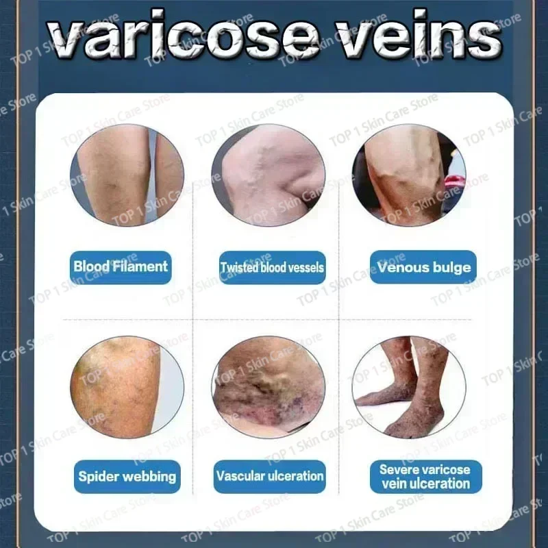 Восстанавливающий крем от варикозного расширения вен Tongmai эффективное