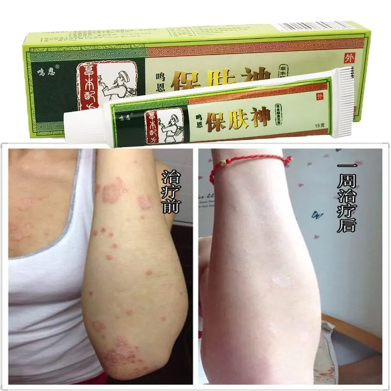 

Psoriasis Antibacterial Cream Dermatitis Eczematoid Ointment Effective Anti-Itch （With Retail Box ）15g