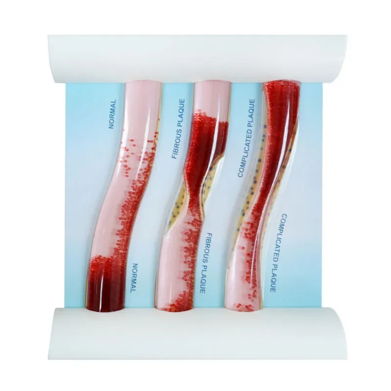 Трехсудочная модель сосудистый: здоровая артерия и симуляция блокировки в