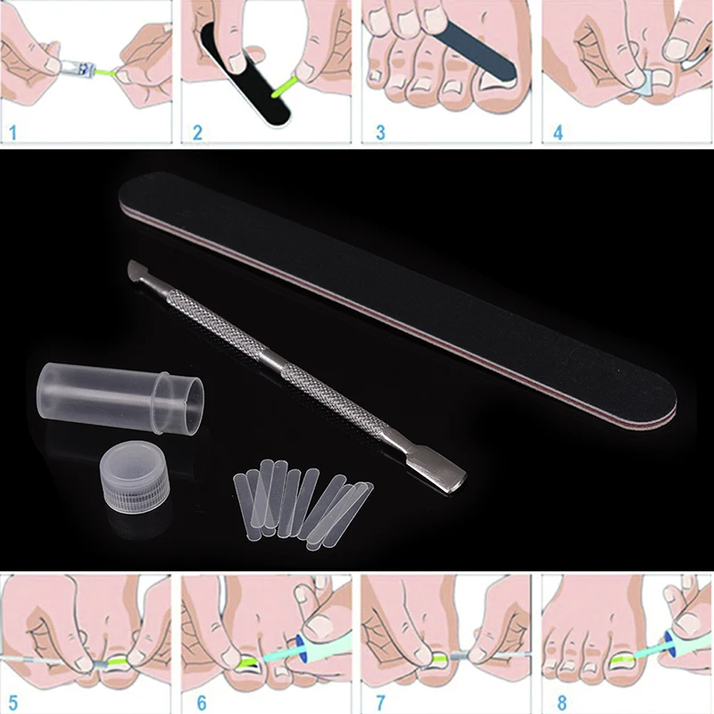 

Pedicure Foot Toe Nail Ingrown Toenail Correction Tool set Nail Treatment Elastic Patch Sticker Straightening Brace Foot Care