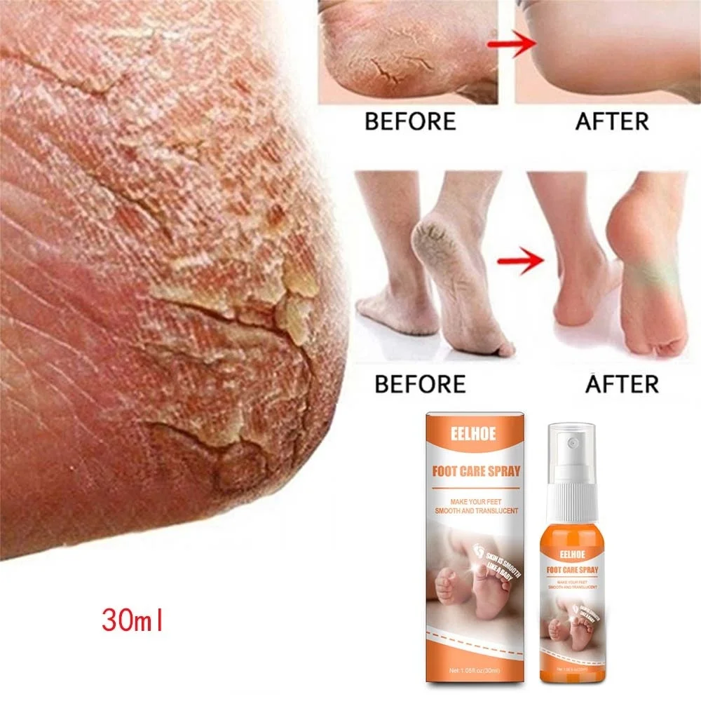 

Foot Peeling Spray Herbal Anti Crack Foot Serum Removal Callus Dead Skin Pedicure Exfoliating Moisturizing Hands Feet Care Tools